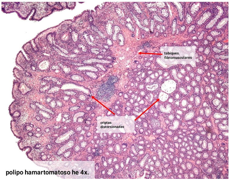 Pólipo mioglandular