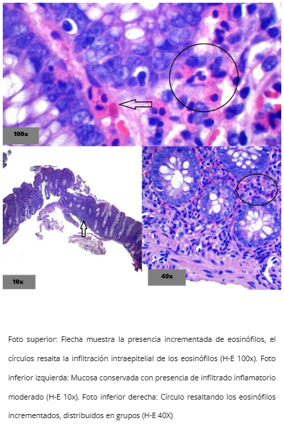 Colitis Eosinofílica - Vista general