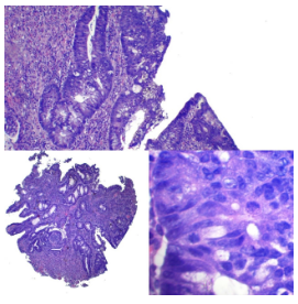 Adenoma tubular