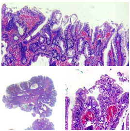Adenoma tubular