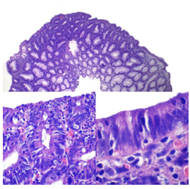 Adenoma tubular