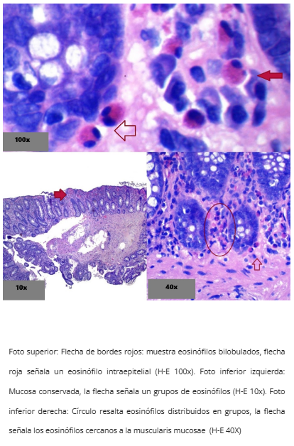 Infiltrado eosinofílico