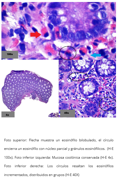 Microabscesos eosinofílicos