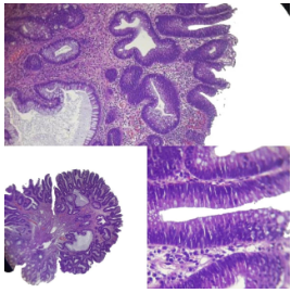 Adenoma tubular