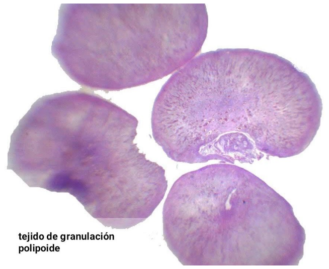Infiltrado inflamatorio