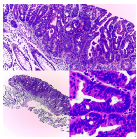 Adenoma tubular
