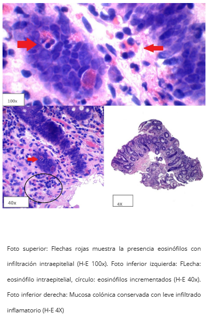 Criptitis eosinofílica