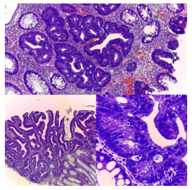 Adenoma tubular