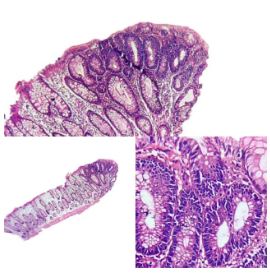 Adenoma tubular