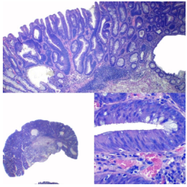Adenoma tubular