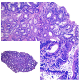 Adenoma tubular
