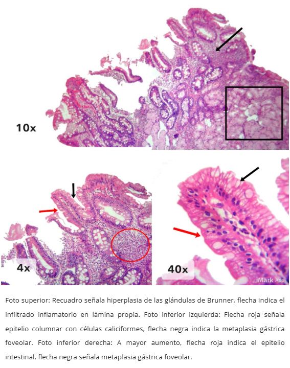 Duodenitis péptica