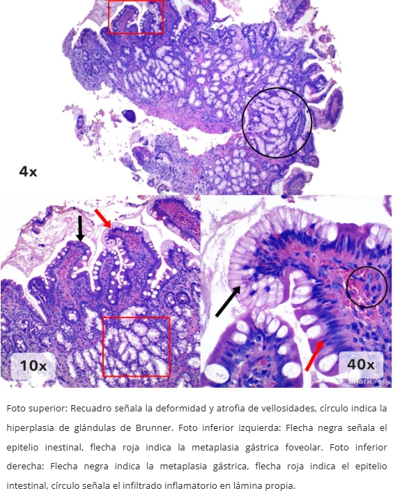 Microscopía duodenitis