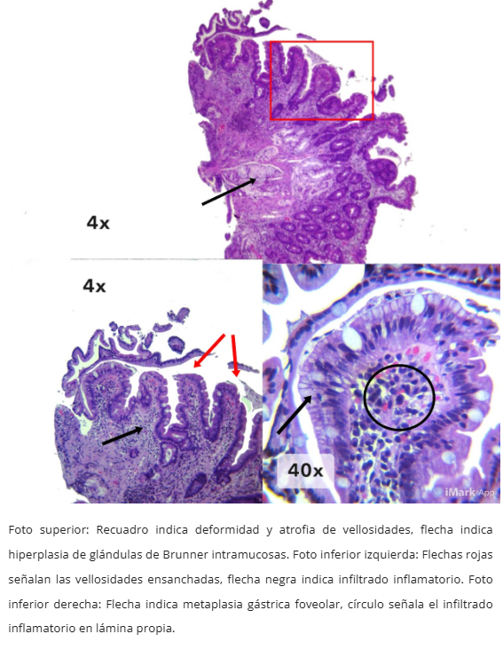Metaplasia gástrica