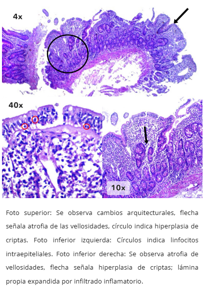 Sobrecrecimiento bacteriano