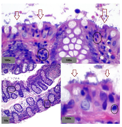 Espiroquetosis - Vista general