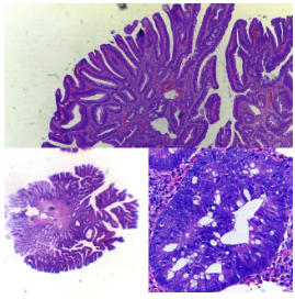 Adenoma velloso