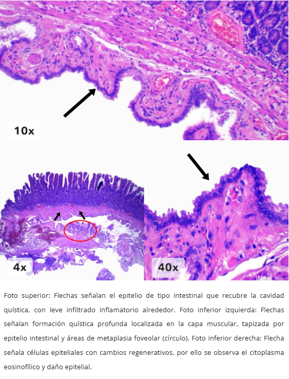 Enteritis Quística Profunda