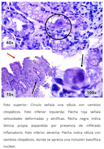Enteritis por CMV