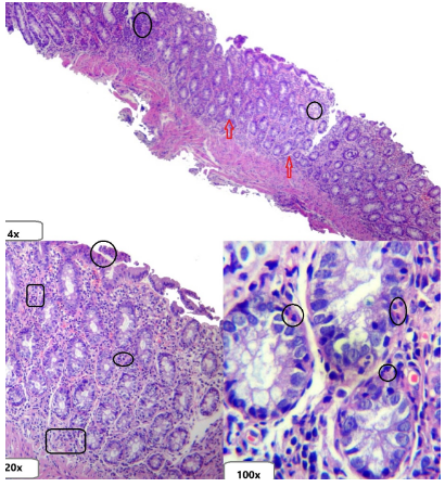 Infiltrado inflamatorio