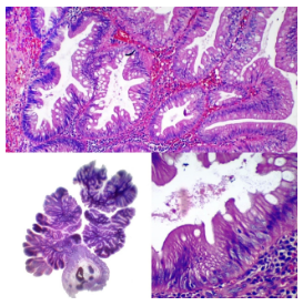 Adenoma aserrado