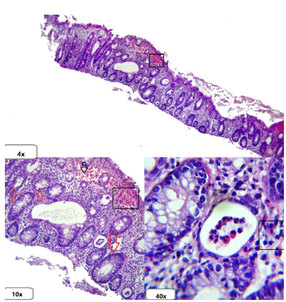 Microabscesos crípticos