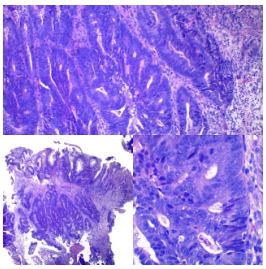 Adenocarcinoma colorrectal