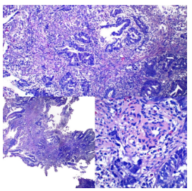 Adenocarcinoma colorrectal