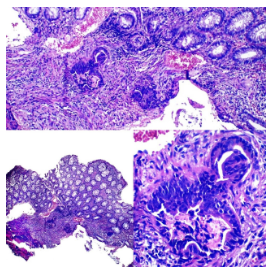 Adenocarcinoma colorrectal