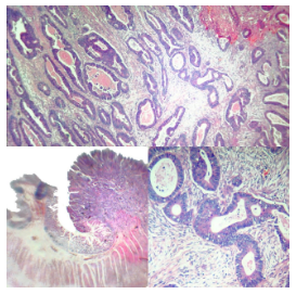 Adenocarcinoma colorrectal
