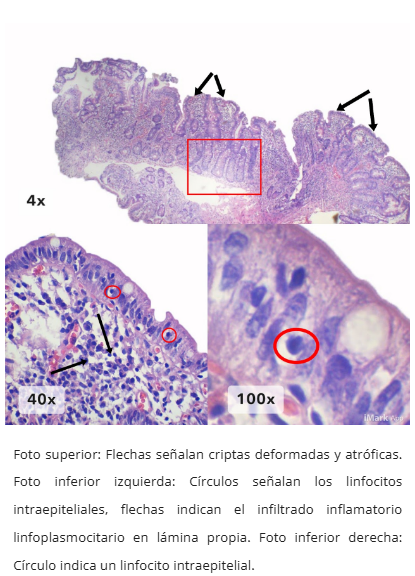 Atrofia vellositaria