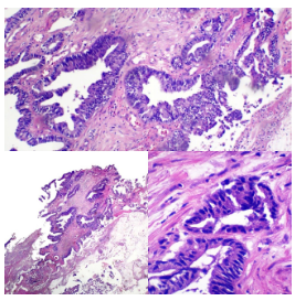 Adenocarcinoma colorrectal