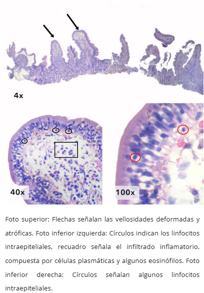 Hiperplasia de criptas