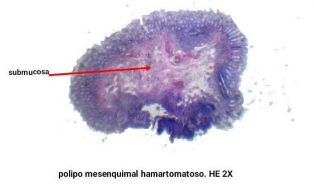 Pólipo hamartomatoso mesenquimal