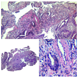 Adenocarcinoma colorrectal