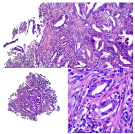 Adenocarcinoma colorrectal