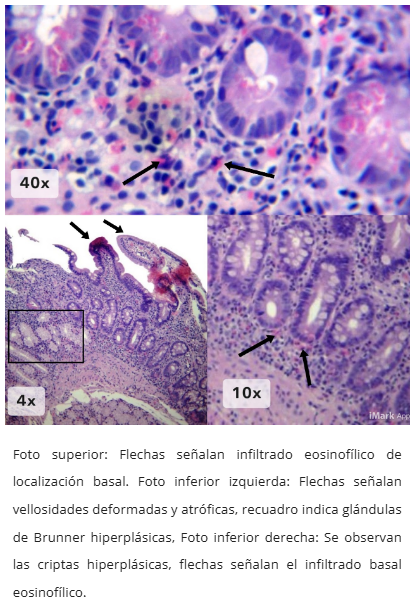 Enteritis eosinofílica
