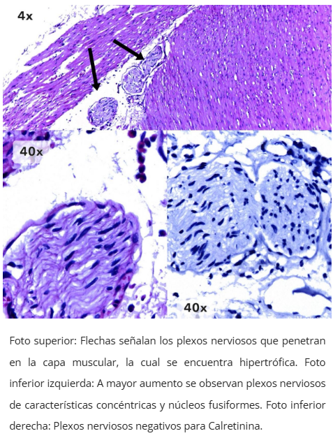 Enfermedad de Hirschsprung