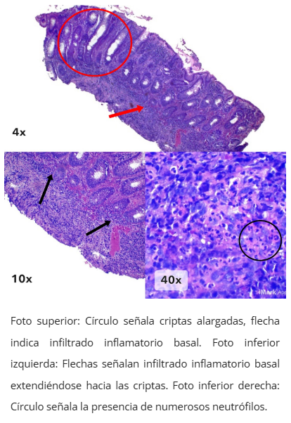 Infiltrado inflamatorio