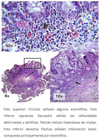 Forma mucosa