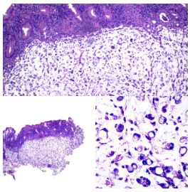 Adenocarcinoma mucinoso de colon