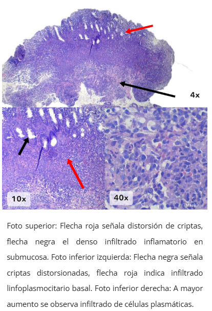 Hipertrofia muscular