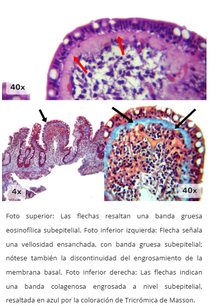 Enteritis colagenosa