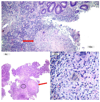 Colitis Tuberculosa - Vista general