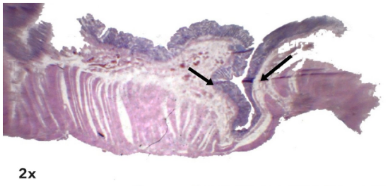 Diverticulosis
