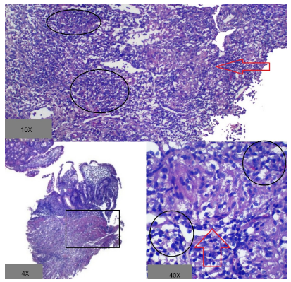 Diagnóstico diferencial Crohn 2