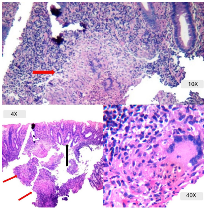 Granulomas tuberculosos