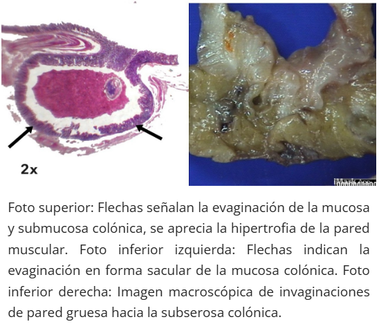 Diverticulosis