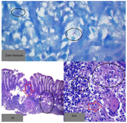 Diagnóstico diferencial histoplasmosis