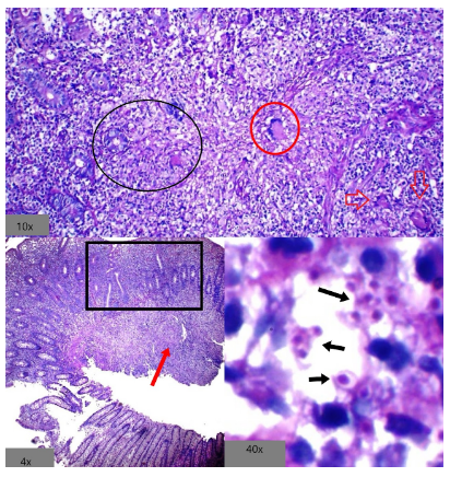 Colitis por Histoplasma - Vista general